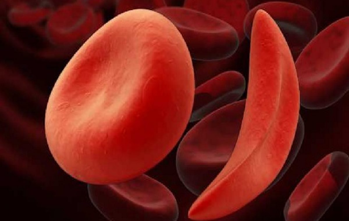 Município vai ganhar Centro de Apoio e Acompanhamento à Pessoa com Doença Falciforme